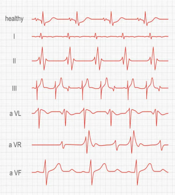 ECG(Electrocardiogram)