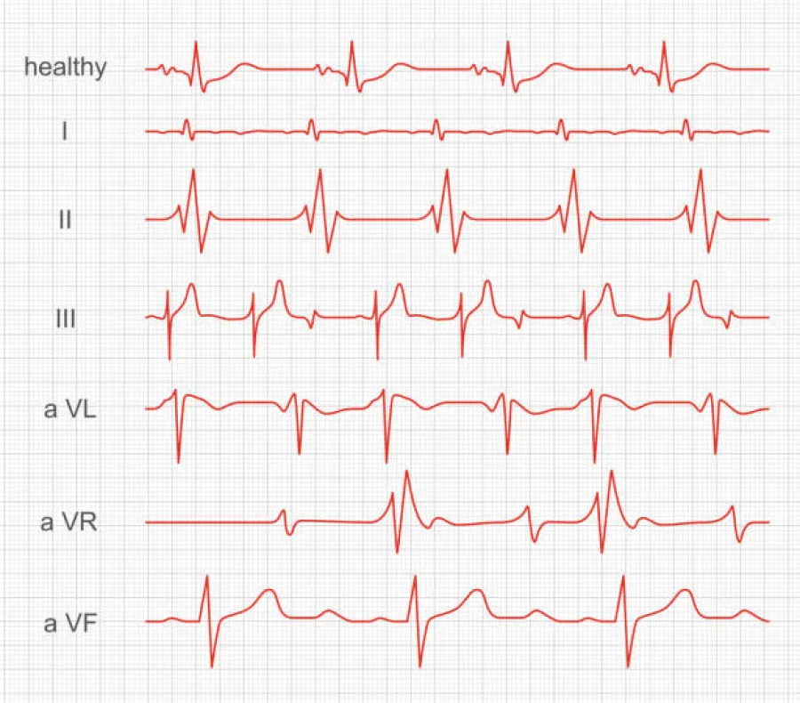 ECG(Electrocardiogram)